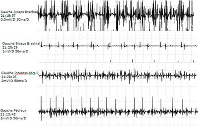 Diagnostic work-up and phenotypic characteristics of a family with variable severity of distal arthrogryposis type 2B (Sheldon-Hall syndrome) and TNNT3 pathogenic variant